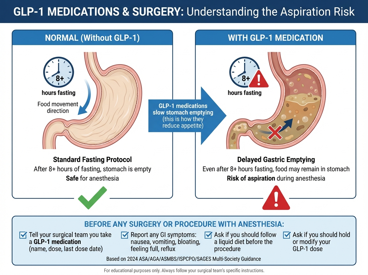 GLP-1 Medications and Surgery: Understanding the Aspiration Risk - infographic comparing normal stomach emptying after 8+ hours fasting versus delayed gastric emptying with GLP-1 medication, showing food may remain in stomach even after standard fasting